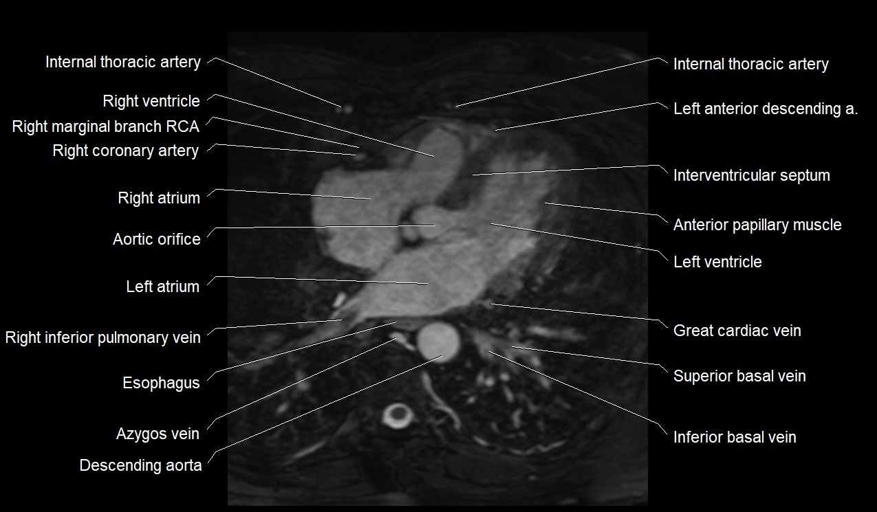 MRI heart coronary arteries and coronary veins anatomy axial image 26.jpg